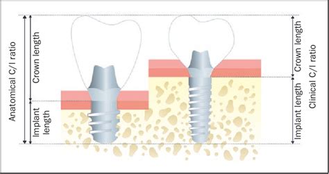 Figure 1 From The Effect Of Crown To Implant Ratio On The Clinical