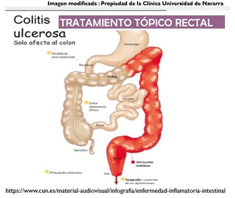 Colitis Ulcerosa Importancia Del Tratamiento Rectal Eii La Fe