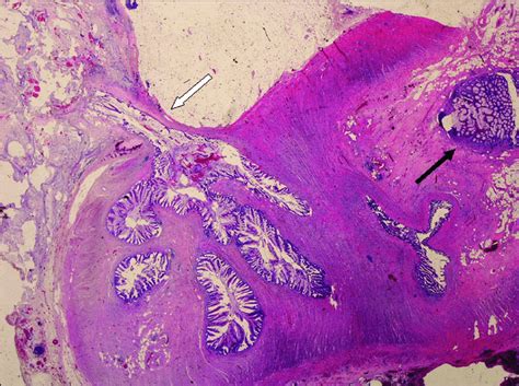 Mucocele Histology