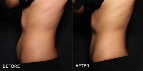 Coolsculpting Elite In Kelowna Bc Dermmedica