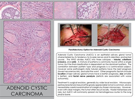 Adenoid Cystic Carcinoma | Iowa Head and Neck Protocols