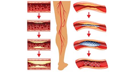 ANGIOPLASTIA DOS MEMBROS INFERIORES Dr Marcos Barros