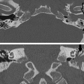 Petrous bone CT scan, axial view. | Download Scientific Diagram