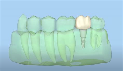 Dental Implants Anchorage Ak Chugach Dental