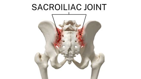 Sacroiliac Si Joint Dysfunction Orthopaedic Spine Surgery Singapore