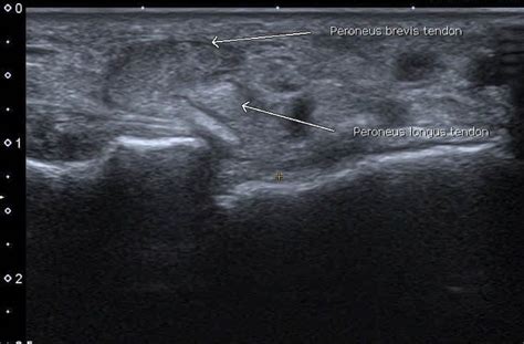 Peroneal Tendonitis Ultrasound