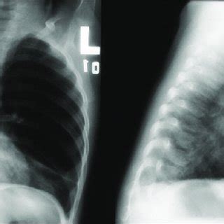 Chest Computed Tomography Showing Congenital Lobar Emphysema With