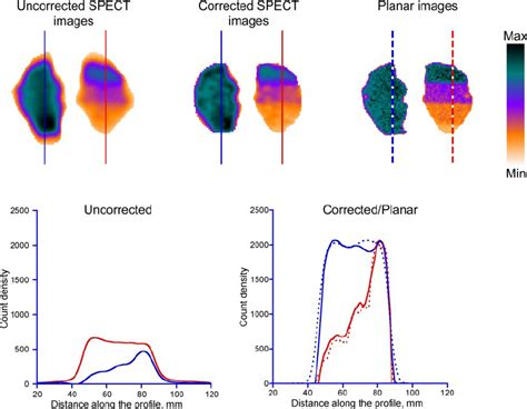 Data Obtained From Single Photon Emission Computed Tomography SPECT