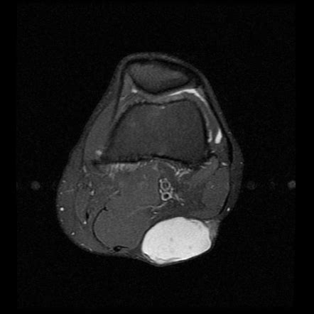 Epidermal Inclusion Cyst Removal