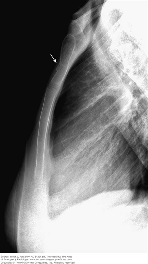 Traumatic Conditions Of The Chest Anesthesia Key