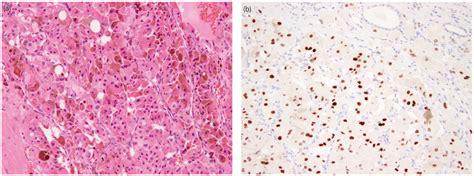 Microscopic Findings A Hematoxylin And Eosin Staining Revealed A