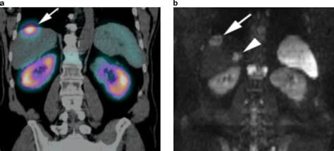 A Coronal Somatostatin Receptor Scintigraphy Image Showed One Liver