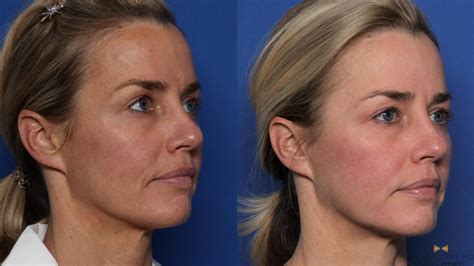 Sciton Laser Before And After Pictures Case 525 Fort Worth