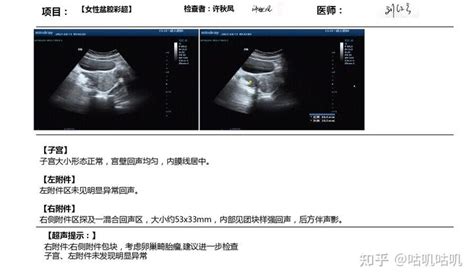 28岁畸胎瘤单孔腹腔镜微创手术🏥 知乎