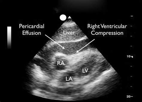 The Role Of Bedside Ultrasound In The Diagnosis Of Pericardial Effusion