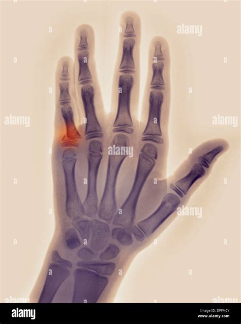 X Ray Of Hand With Fracture Of A Proximal Phalanx Stock Photo 65498523