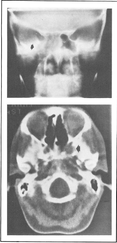 Jugular Foramen Syndrome Semantic Scholar