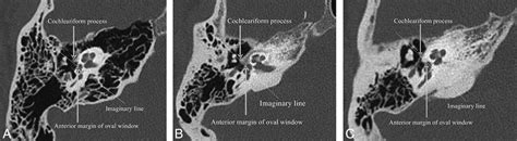 Otosclerosis Histology