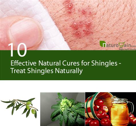 10 Effective Natural Cures For Shingles Treat Shingles Naturally