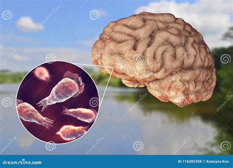 Cerveau Consommation De L Infection D Amibe Naegleriasis Photo Stock