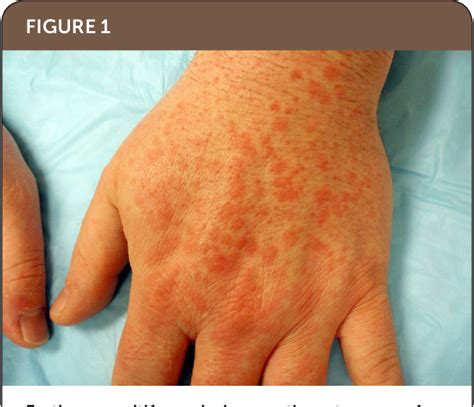 Erythema Multiforme Minor Hand