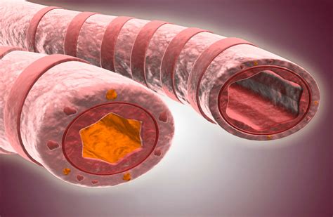 Mucus Plugging Associated With Airway Wall Thickening In Asthma And