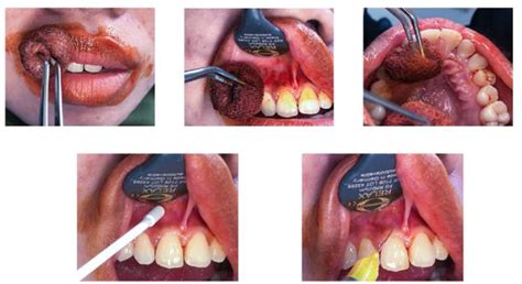 Figure 2 From Management Of Frenectomy Anterior Upper Arch Before