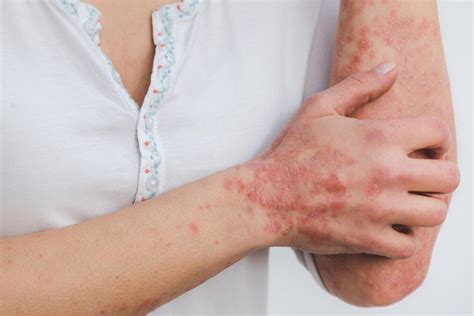 Kelebek Hastalığı Lupus Nedir Belirtileri Nelerdir