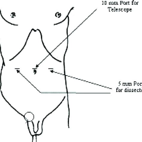 Preoperative Photograph Showing Bilateral Giant Inguinal Hernias