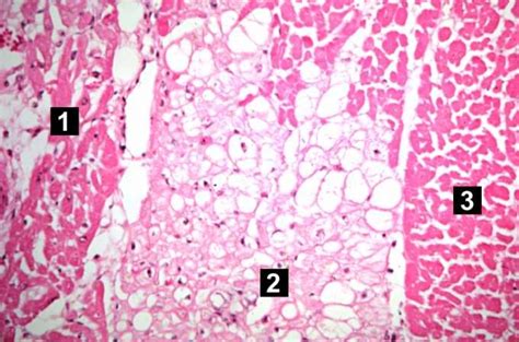 St Elevation Myocardial Infarction Case Study Four Wikidoc