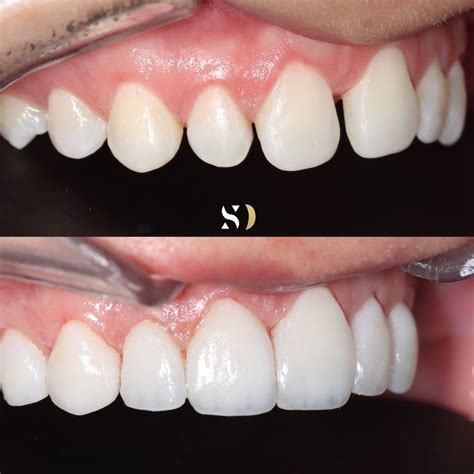 Diseño de sonrisa Diseños de sonrisa Disenos de unas Dentista