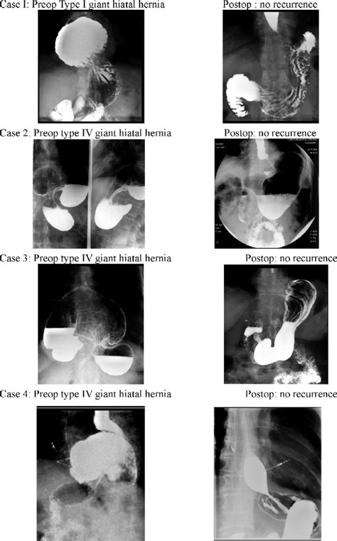 Radiologic Preoperative And Postoperative Evaluation Without Hiatal Download Scientific Diagram