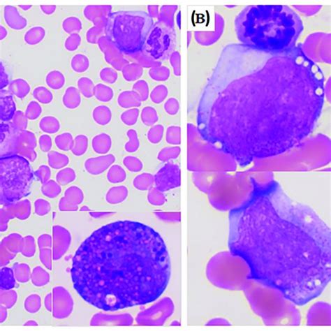 Bone Marrow Smear Morphology Of Our Patient With Cbf Aml Through