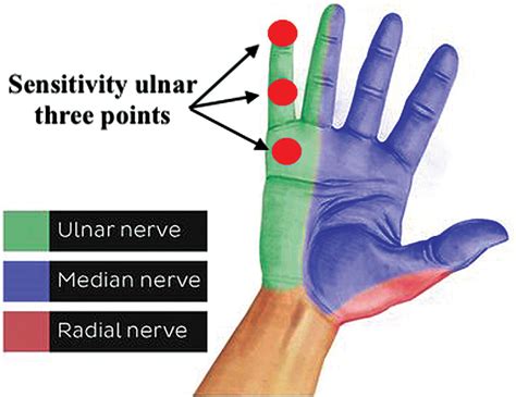 Scielo Brasil Endoscopic Cubital Tunnel Release In Leprosy Neuritis