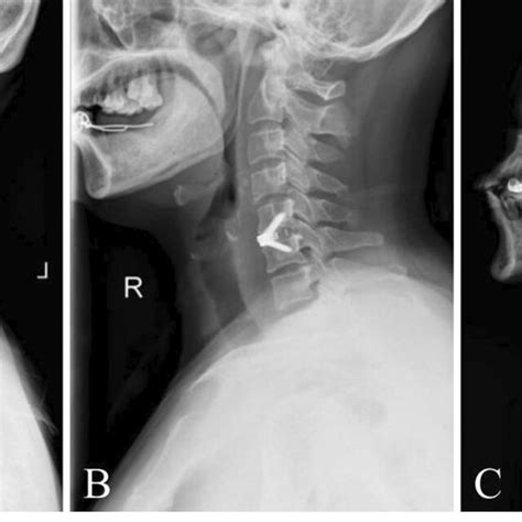 Postoperative Lateral Radiographs Showing A A Patient With C5 6 Download Scientific Diagram