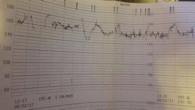 Cuándo se debe realizar una cardiotocografía CTG en el embarazo