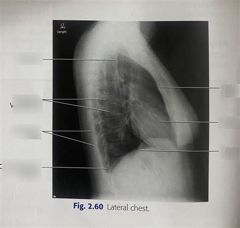 Lateral Chest Xray Diagram Quizlet