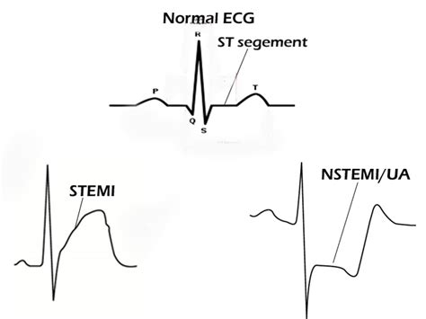 Learnonly Heart Types Of Heart Attack Stemi Myocardial Infarction