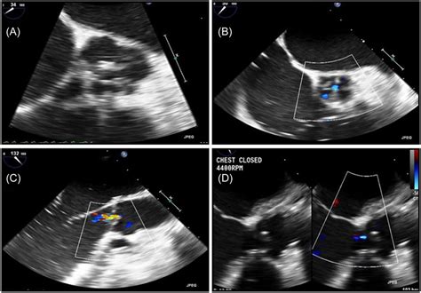 A Precardiopulmonary Bypass Midesophageal Aortic Valve Short Axis