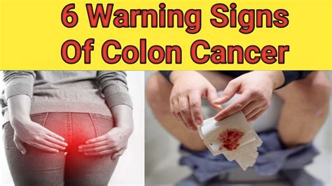 6 Early Warning Signs Of Colon Cancer Colorectal Cancer Scr Youtube