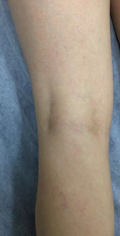 Spider Vein Treatment Brisbane Results — The Leg Vein Doctor Brisbane