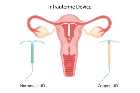 Intrauterine Contraceptive Device Overview Types Advantages Meril