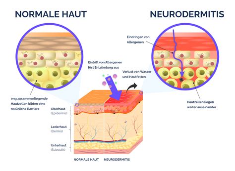 Neurodermitis Entzündung Ursachen Nia