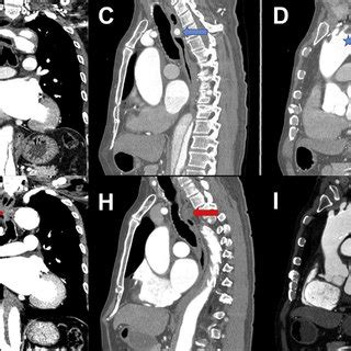 Preoperative And Postoperative Computed Tomography Angiography Cta In