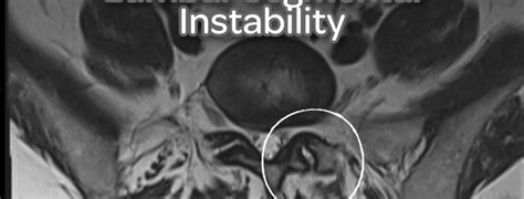 Diagnosing Methodology For Lumbar Segmental Instability