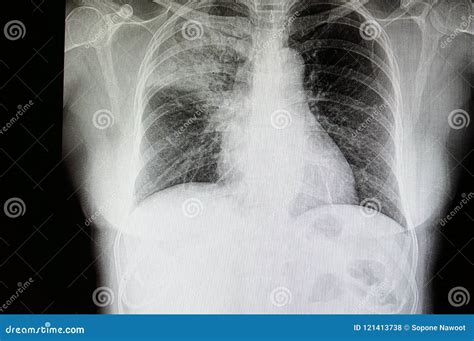 Lobar Pneumonia Chest X Ray