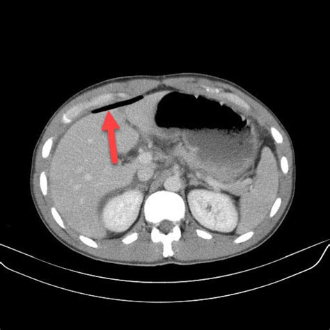 Pneumoperitoneum Radiology For Beginners By Dr Samuel Kobba