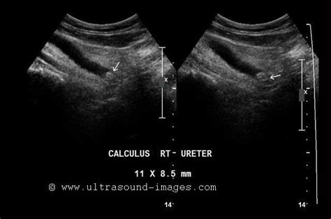 Hydroureter Ultrasound