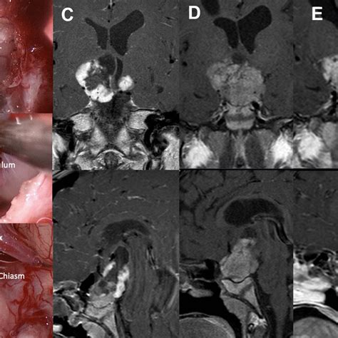 Case of combined approach. A Preoperative coronal-sagittal MRI. B Optic ...