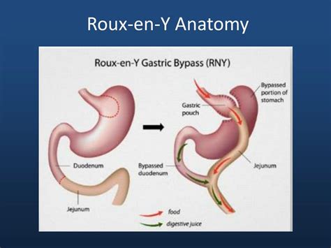 PPT - GI Complications of Gastric Bypass PowerPoint Presentation, free download - ID:1831014